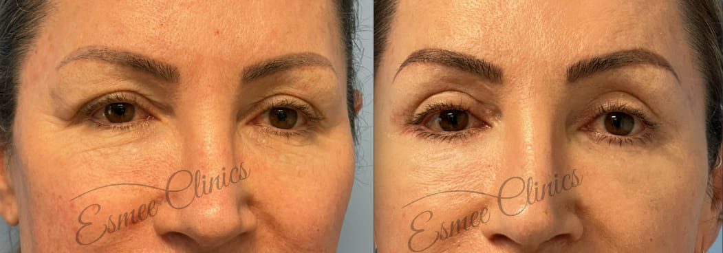 Before and After img